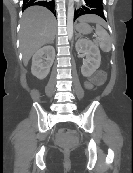 File:Colonic pseudo-obstruction (Radiopaedia 79752-92980 B 42).png