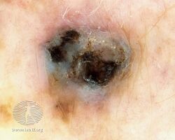 Dermoscopy of nodular melanoma (DermNet NZ nodular-melanoma-12).jpg