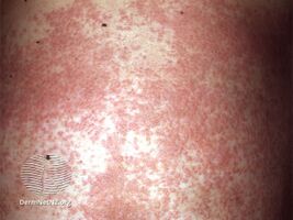 Disseminated secondary eczema