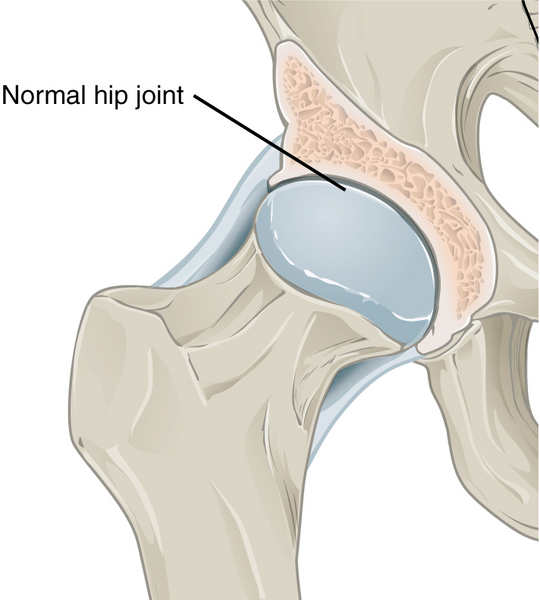 File:Hip osteoarthritis (illustration) (Radiopaedia 47973-52754 None 1).png