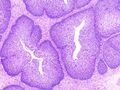 Inverted papilloma (histology) (Radiopaedia 14662).jpg