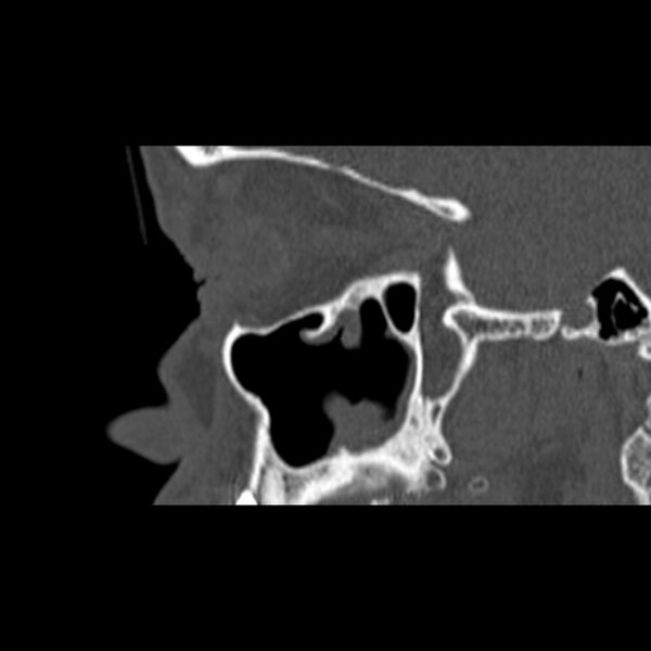 File:Nasal septal perforation (Radiopaedia 25030-25289 Sagittal bone window 4).jpg