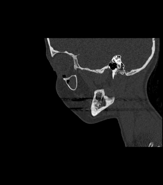 File:Nasoorbitoethmoid fracture (Radiopaedia 90044-107205 Sagittal bone window 108).jpg