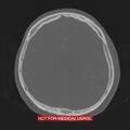 Nasopharyngeal carcinoma recurrence - skull base destruction (Radiopaedia 29107-29490 Axial bone window 38).jpg