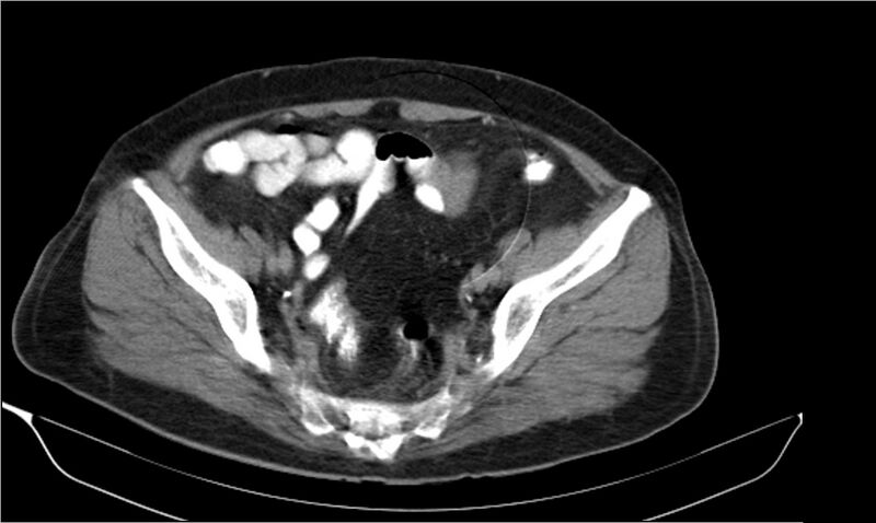 File:Necrotizing pancreatitis (Radiopaedia 20595-20495 Axial C+ delayed 38).jpg