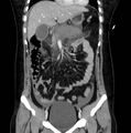 Necrotizing pancreatitis (Radiopaedia 23001-23031 B 25).jpg