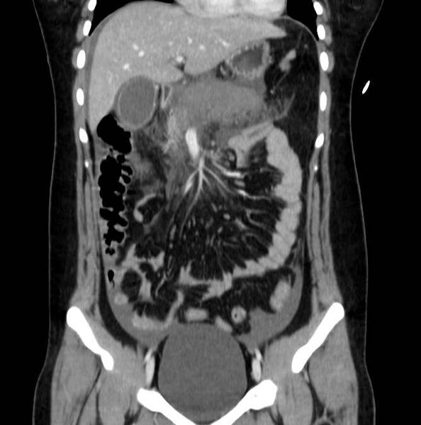 File:Necrotizing pancreatitis (Radiopaedia 23001-23031 B 25).jpg