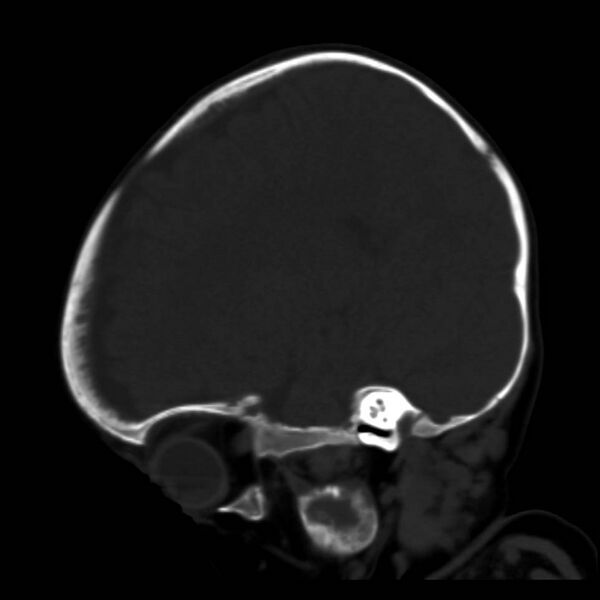 File:Neuroblastoma with skull metastases (Radiopaedia 30326-30958 Sagittal bone window 29).jpg