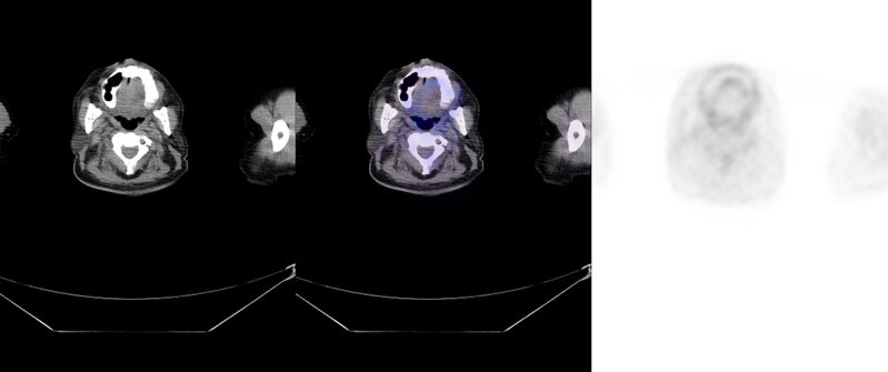 File:Non-Hodgkin lymphoma involving seminal vesicles with development of interstitial pneumonitis during Rituximab therapy (Radiopaedia 32703-33752 ax CT Fus PET 3).jpg