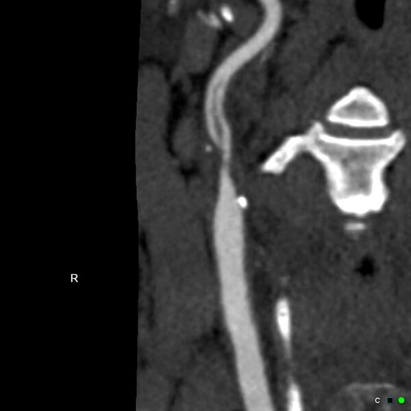 File:Non-occlusive intraluminal internal carotid artery thrombus (Radiopaedia 37751-39658 A 2).jpg