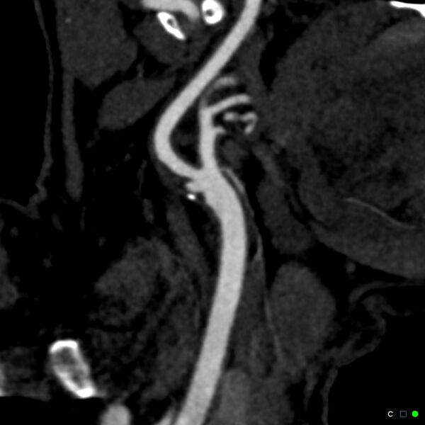 File:Non-occlusive intraluminal internal carotid artery thrombus (Radiopaedia 37751-39658 C 23).jpg