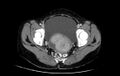 Non-puerperal uterine inversion (Radiopaedia 78343-91094 A 50).jpg