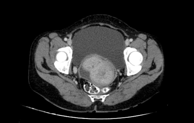 File:Non-puerperal uterine inversion (Radiopaedia 78343-91094 A 50).jpg