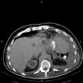 Non Hodgkin lymphoma in a patient with ankylosing spondylitis (Radiopaedia 84323-99621 Axial non-contrast 27).jpg