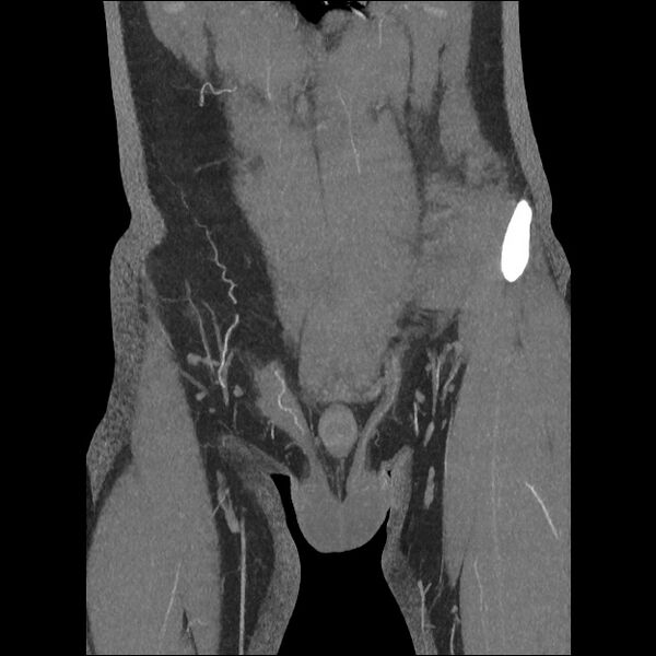 File:Normal CT angiogram of pelvis (Radiopaedia 45390-49430 B 13).jpg