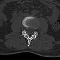 Normal CT lumbar spine (Radiopaedia 53981-60118 Axial bone window 41).jpg
