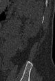 Normal CT lumbar spine (Radiopaedia 53981-60118 Sagittal bone window 102).jpg