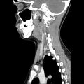 Normal CT of the neck (Radiopaedia 14575-14500 Sagittal C+ 35).jpg
