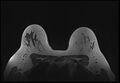 Normal breast MRI - dense breasts (Radiopaedia 80454-93850 Axial T1 163).jpg