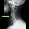 Normal cervical spine radiographs (Radiopaedia 32505-96697 A 10).jpeg