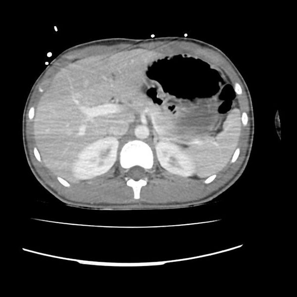 File:Normal dual-phase trauma CT chest,abdomen and pelvis (Radiopaedia 48092-52899 A 56).jpg