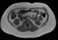 Normal liver MRI with Gadolinium (Radiopaedia 58913-66163 Axial T1 in-phase 9).jpg