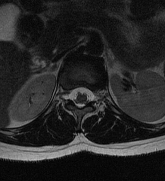 File:Normal thoracic spine MRI (Radiopaedia 41033-43781 Axial T2 31).jpg
