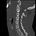 Normal trauma cervical spine (Radiopaedia 41017-43760 Sagittal bone window 29).png