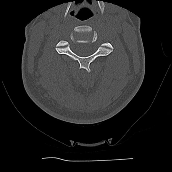 File:Normal trauma spine imaging (Radiopaedia 31753-32686 Axial bone window 33).jpg