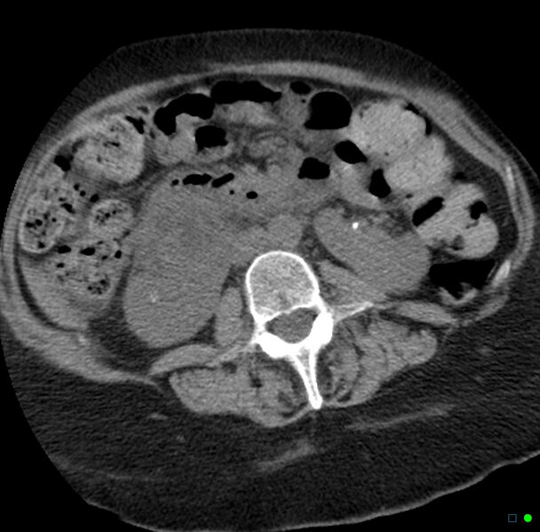File:Obstructed infected horseshoe kidney (Radiopaedia 18116-17898 non-contrast 13).jpg
