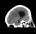 Obstructive hydrocephalus (Radiopaedia 30453-31119 C 10).jpg