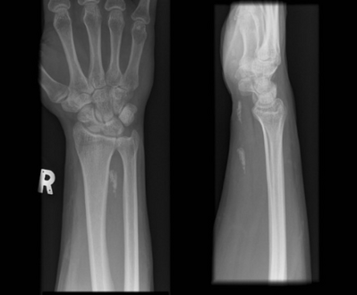 Radiographs of wrist demonstrating Calcific tendonitis of flexor carpi ulnaris.