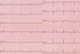 EKG shows a sinus bradycardia at 40 bpm with a first-degree atrio-ventricular block