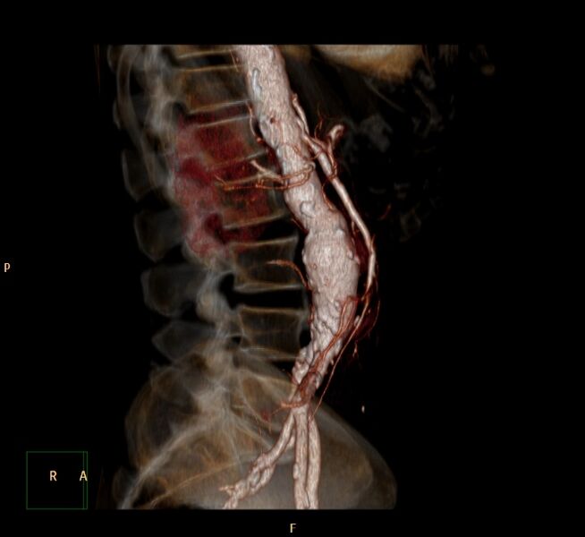 File:Abdominal aortic aneurysm (Radiopaedia 23703-23856 3D 7).jpg