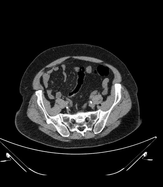 File:Abdominal aortic aneurysm with thrombus fissuration (Radiopaedia 46218-50618 Axial non-contrast 43).jpg