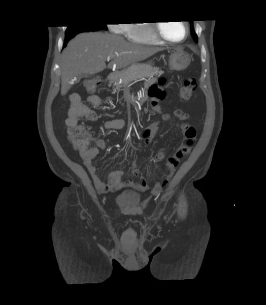 File:Abdominal aortic aneurysm with thrombus fissuration (Radiopaedia 46218-50618 Coronal C+ arterial phase 28).jpg