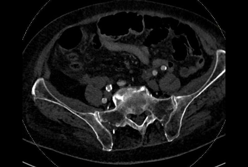File:Abdominal aortic aneurysm with thrombus fissuration (Radiopaedia 73192-83919 Axial C+ arterial phase 161).jpg