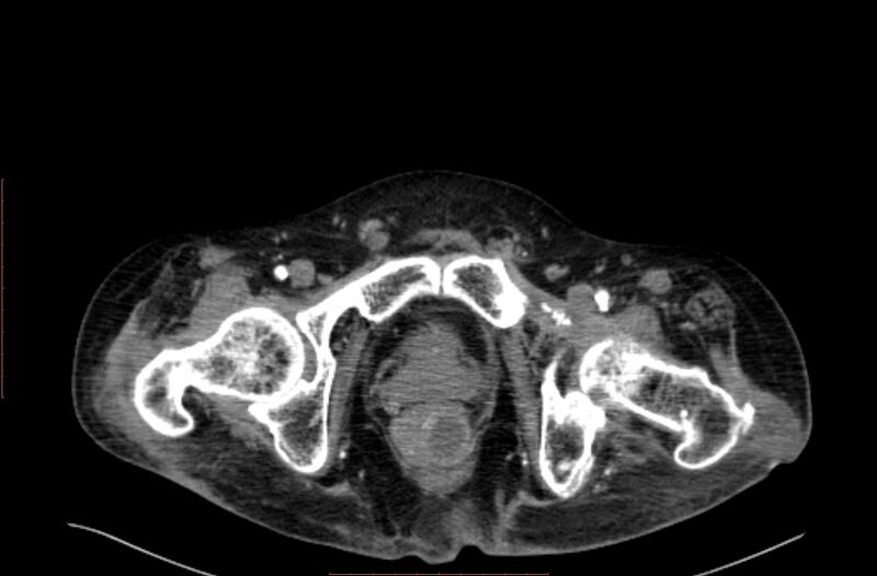 File:Abdominal aortic interposition tube graft and aneurysm thrombosis (Radiopaedia 71438-81857 Axial C+ arterial phase 244).jpg