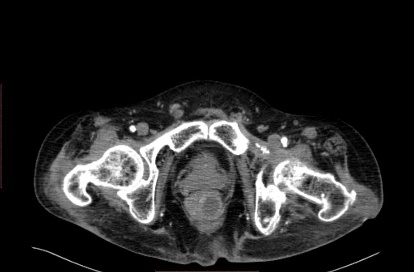 Abdominal aortic interposition tube graft and aneurysm thrombosis (Radiopaedia 71438-81857 Axial C+ arterial phase 244).jpg