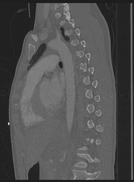 File:Abdominal multi-trauma - devascularised kidney and liver, spleen and pancreatic lacerations (Radiopaedia 34984-36486 Sagittal bone window 22).png