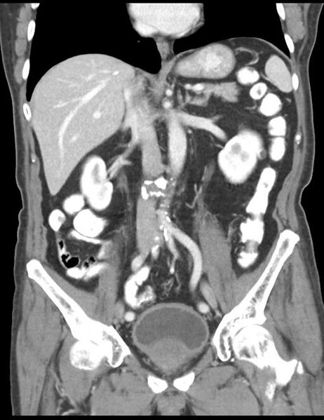 File:Abdominal wall metastasis from colorectal carcinoma (Radiopaedia 31016-31717 Coronal C+ portal venous phase 25).jpg
