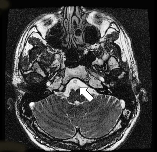 File:Abducens nerve on MRI (Radiopaedia 17384).jpeg