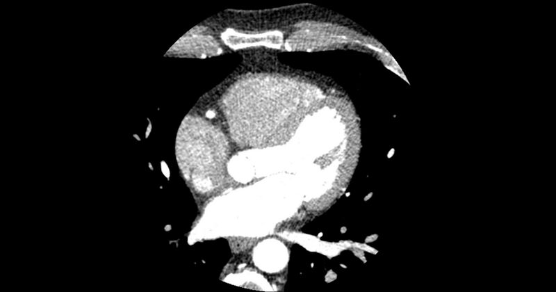File:Aberrant left main coronary artery (ALMCA) arising from the right sinus with interarterial course (Radiopaedia 63251-71814 Axial C+ arterial phase 94).JPG