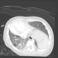 Aberrant left pulmonary artery (pulmonary sling) (Radiopaedia 42323-45435 Axial lung window 29).jpg
