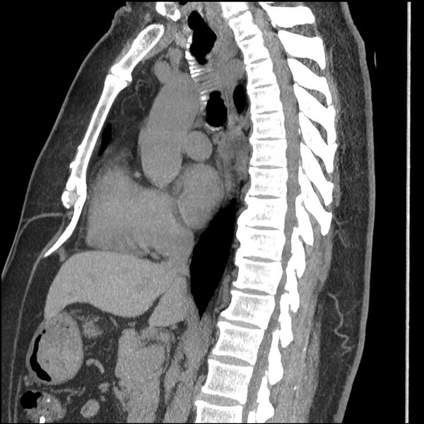 File:Aberrant right subclavian artery (Radiopaedia 40967-43680 Sagittal non-contrast 45).jpg