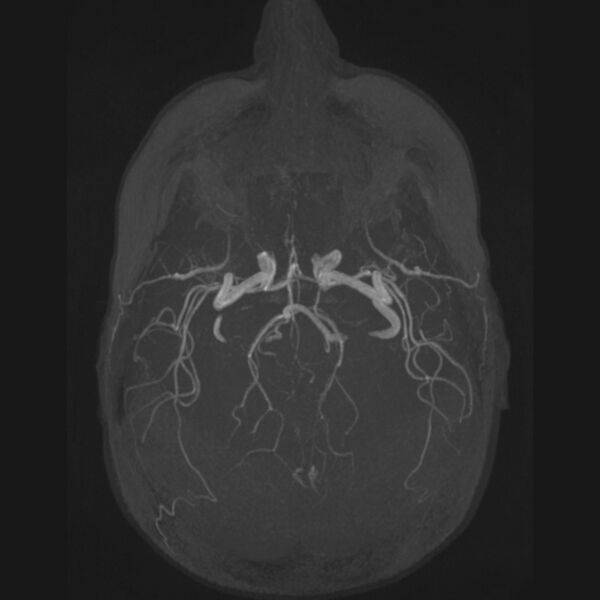 File:Accessory middle cerebral artery and ICA aneurysm (Radiopaedia 22656-22674 B 23).jpg