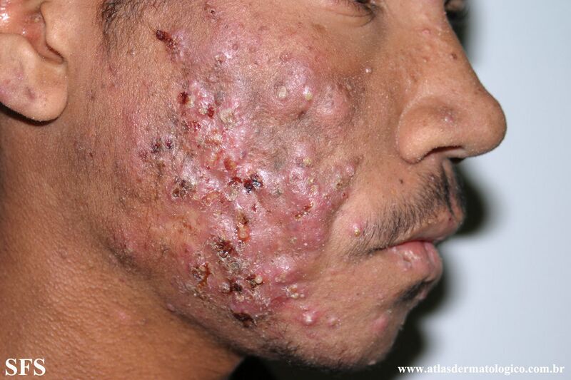 File:Acne (Dermatology Atlas 31).jpg