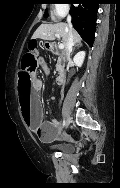 File:Active Crohn disease (Radiopaedia 59394-66750 Sagittal C+ portal venous phase 35).jpg