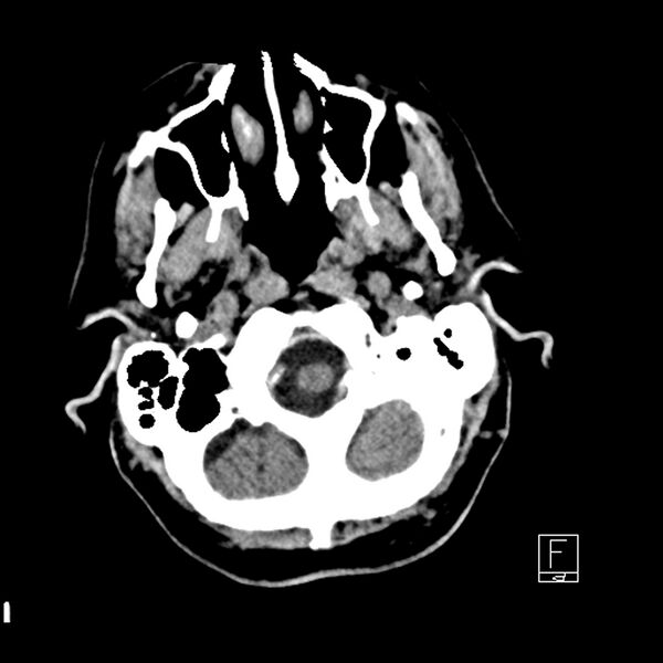 File:Acute ICA ischemic penumbra due to high-grade CCA stenosis (CT perfusion) (Radiopaedia 72038-82529 Axial non-contrast 2).jpg