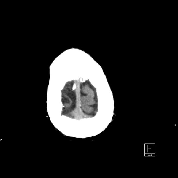 File:Acute ICA ischemic penumbra due to high-grade CCA stenosis (CT perfusion) (Radiopaedia 72038-82529 Axial non-contrast 45).jpg